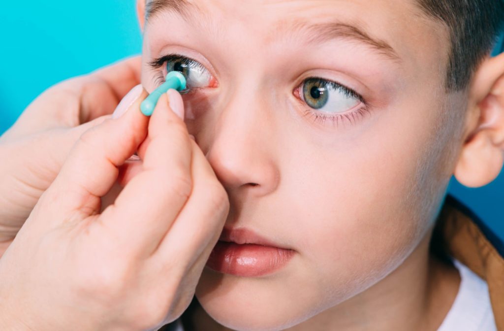 A close-up of a boy getting scleral contact lenses for his myopia. An optometrist's hand is putting the lens on the boy's eye