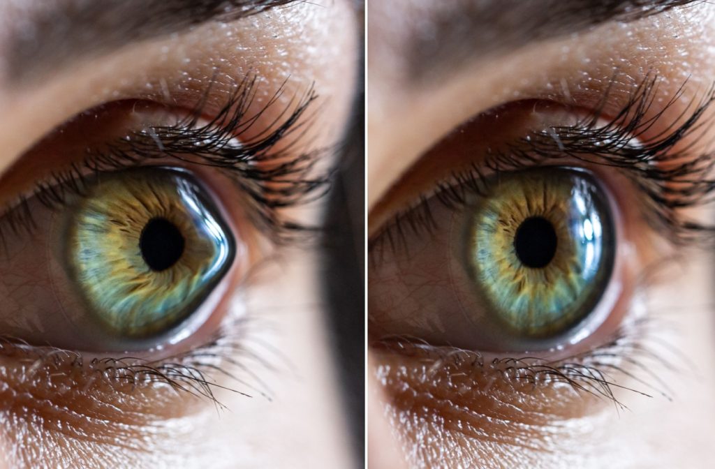 A comparison of a person's eye, before and after keratoconus treatment. Before the eye is bulged. After, it's round.