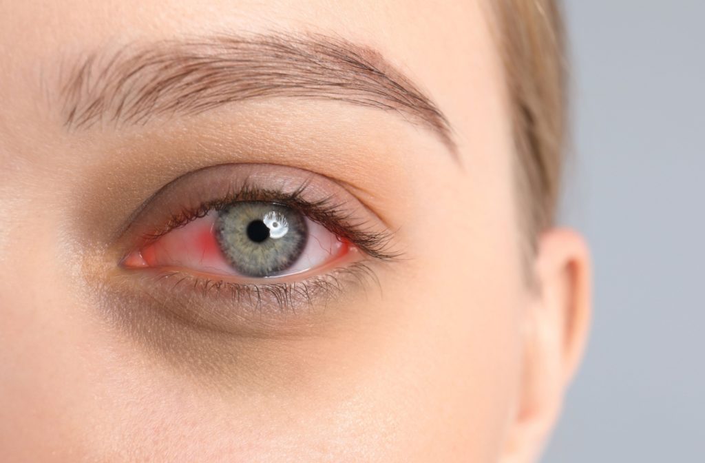 A close-up image of a left eye showing eye redness from dry eye.