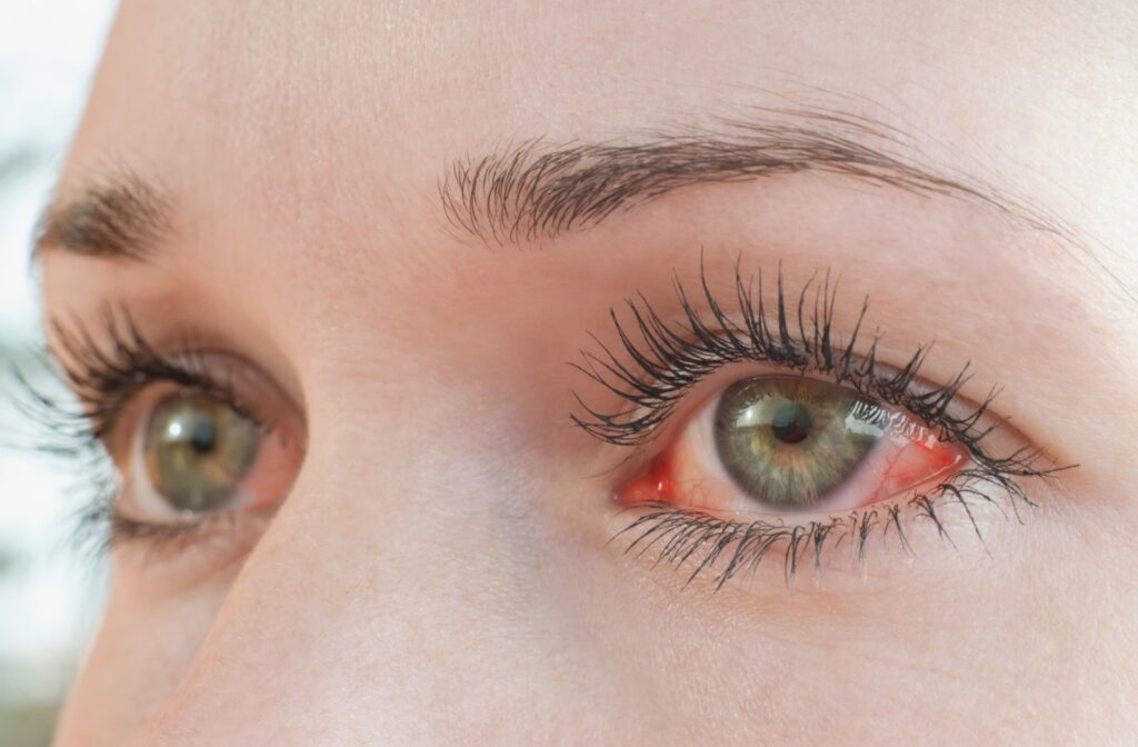 Close-up of someone's red, irritated eyes, possibly due to pink eye.